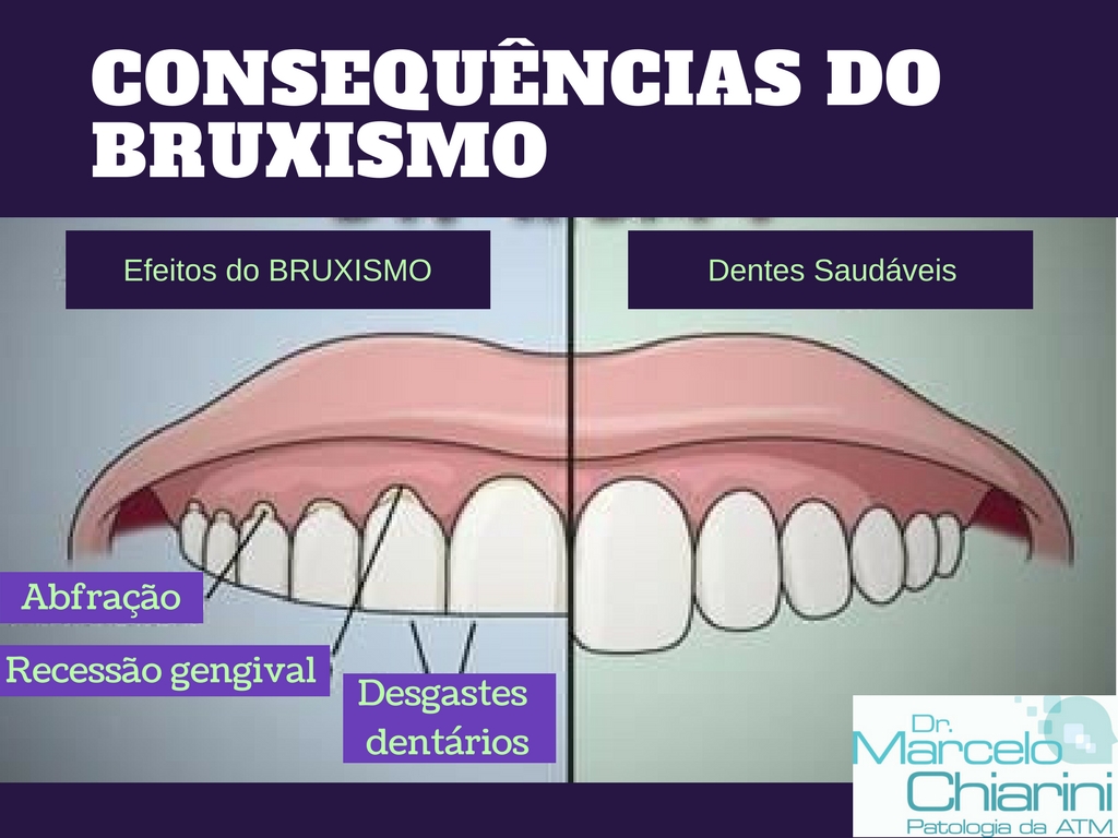 Quais são os principais sintomas da ATM/DTM? - Ortodontia Curitiba